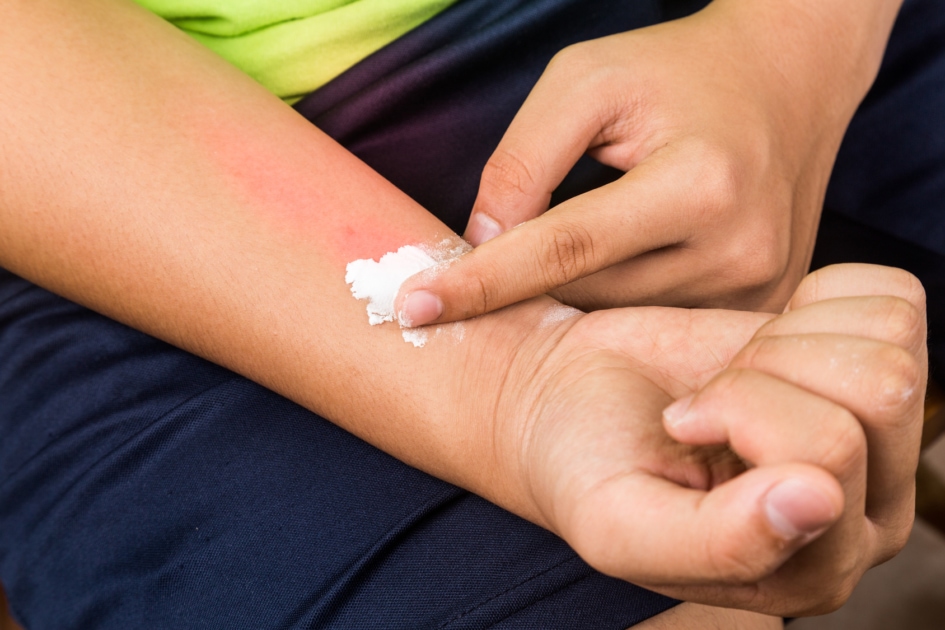 Rubbing baking soda on a mosquito bite on arm.