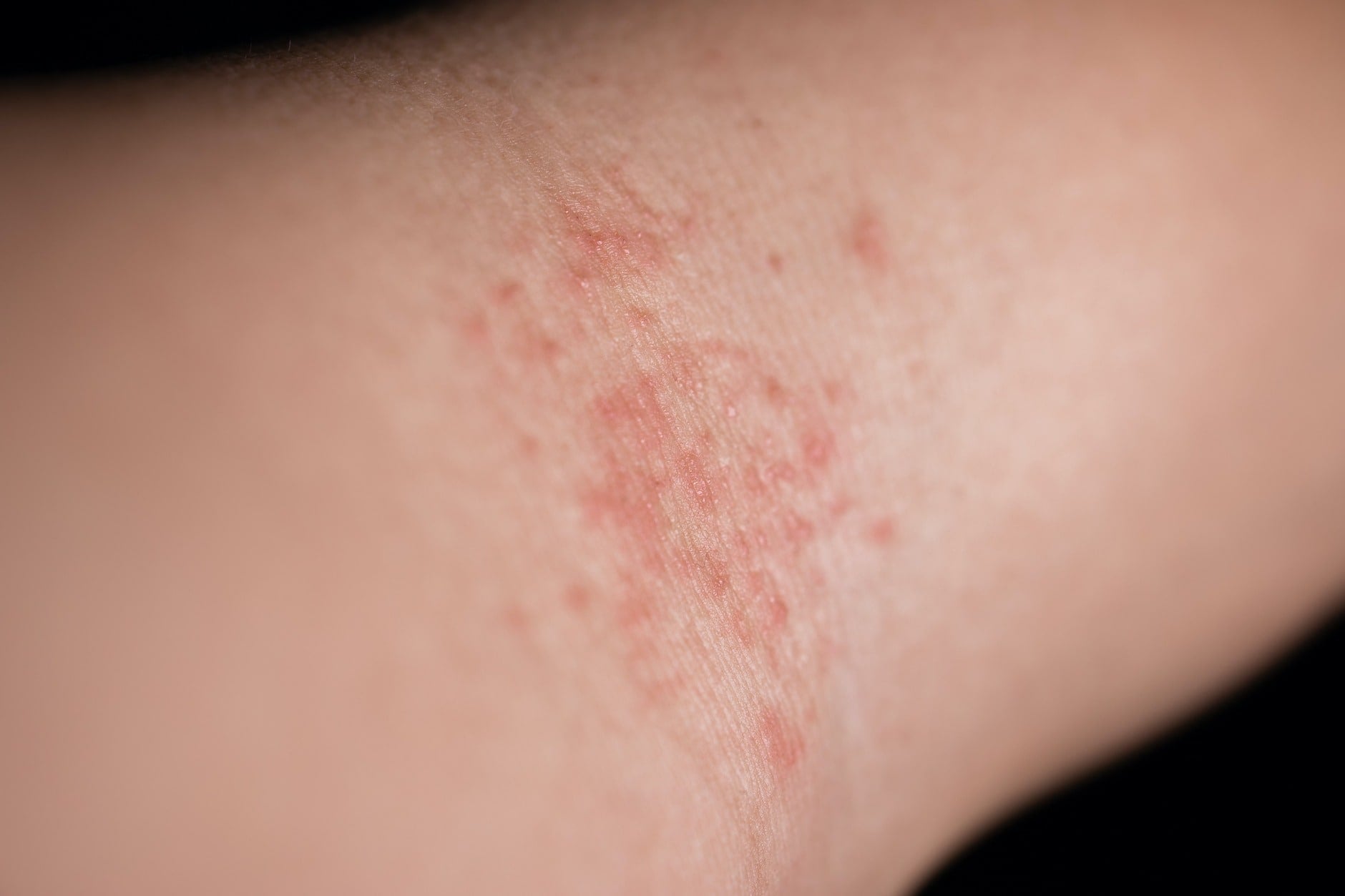 A poison ivy rash on a forearm.