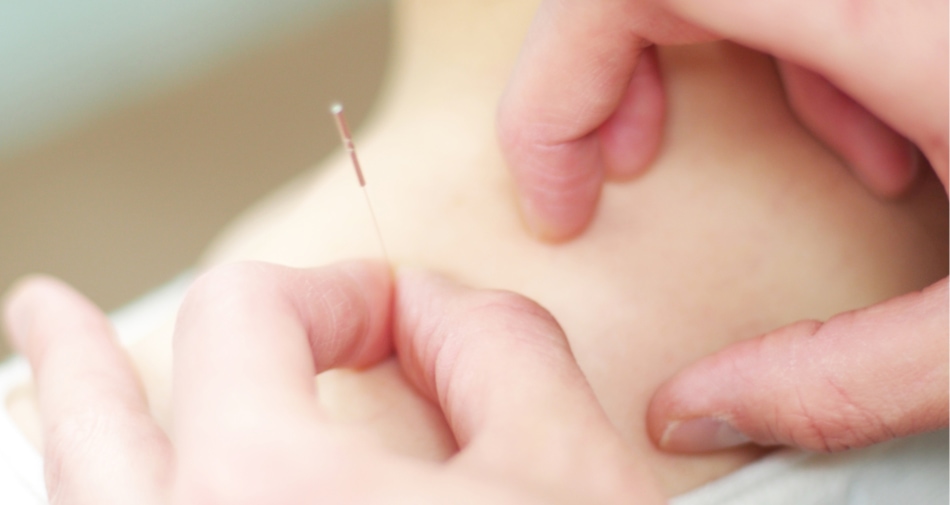 Hands inserting an acupuncture needle.