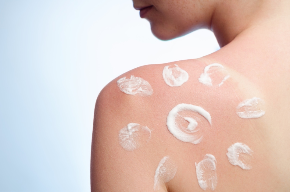 7 Natural Remedies to Soothe Sunburnt Skin