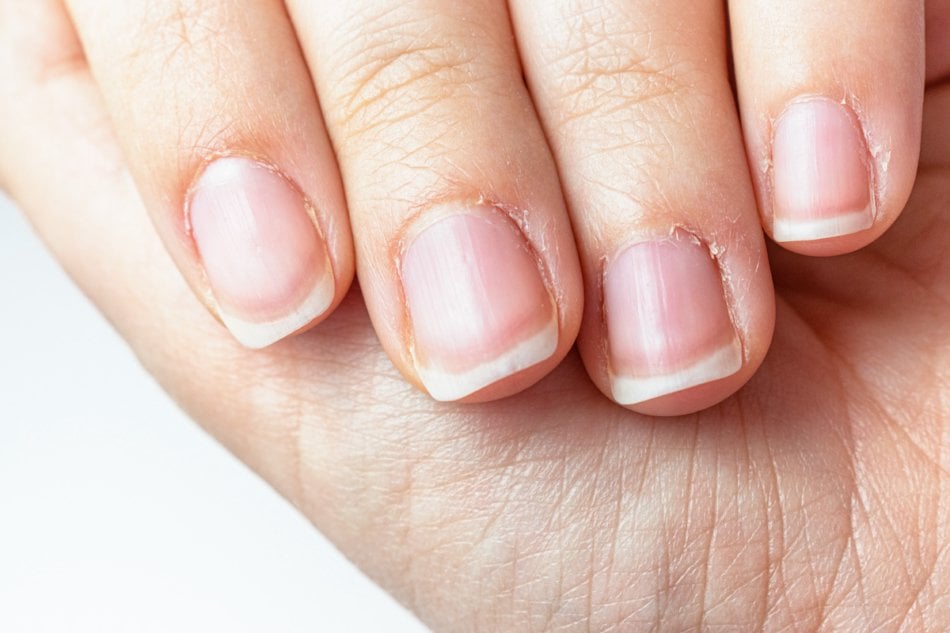 Close up on a female hands with dry skin and hangnails. Long fingernails and cuticles in bad condition. Chapped and neglected hands. Hands care concept. Lack of manicure in a lady fingers.